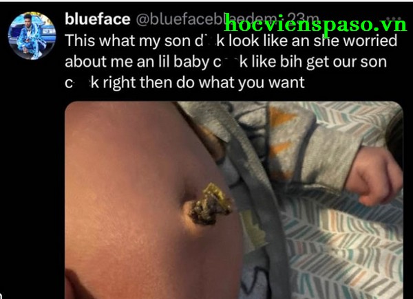 Blueface Baby Hernia Photo